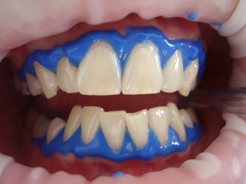 بهترین روش سفید کردن دندان کدام است؟