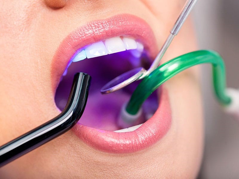 بلیچینگ دندان چیست و هزینه آن چقدر است؟
