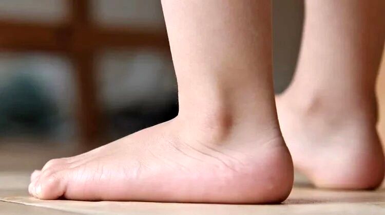 روش تشخیص کف پای صاف در کودکان | صافی کف پا تا چه سنی قابل درمان است؟ | علائم صاف بودن کف پا و راه‌های درمان آن