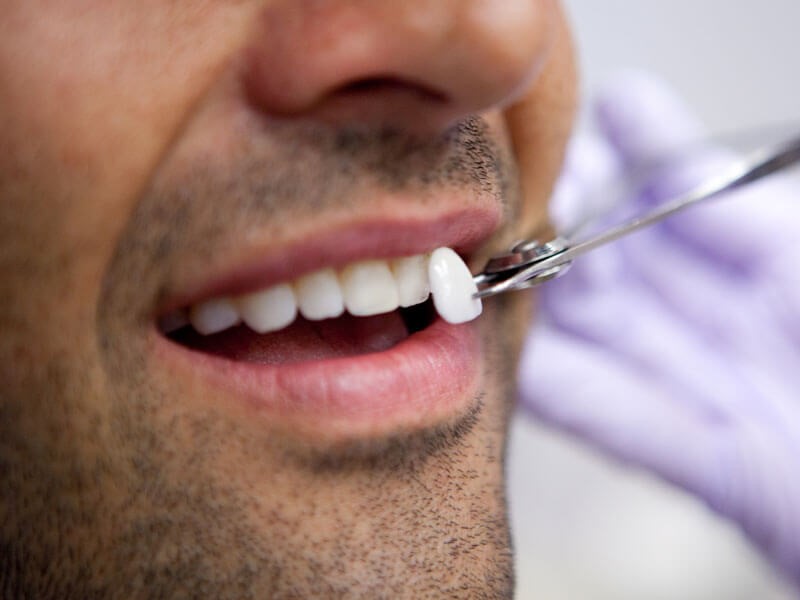 کامپوزیت دندان چیست و هزینه آن چقدر است؟