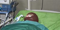 اسیدپاشی روی دوست صمیمی به‌خاطر اختلاف مالی