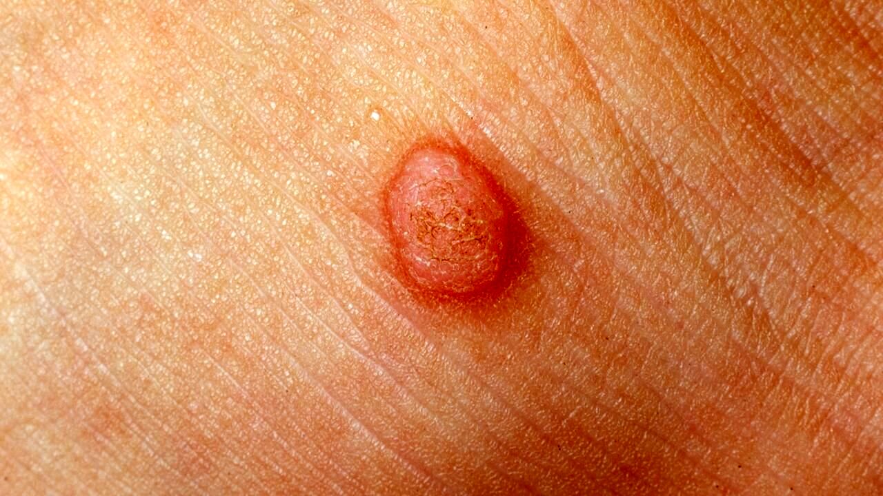 کندن زگیل با ناخنگیر یا بستن نخ خطرناک است؟/ تفاوت‌های مهم خال گوشتی و زگیل 2