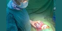 خارج کردن توده‌ای عجیب از شکم بیمار 35 ساله