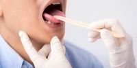 شایع ترین علائم سرطان دهان