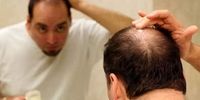 ۵۰درصد ایرانی‌ها مشکل ریزش موی سر دارند