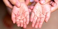 هشدار درباره شیوع سویه جدید تب برفکی در کشور
