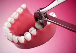 شاید بعد از کشیدن دندان عقل این مشکلات را داشته باشید/ درد بعد از کشیدن دندان عقل و عفونت بعد از کشیدن دندان عقل چقدر جدی است؟ 
