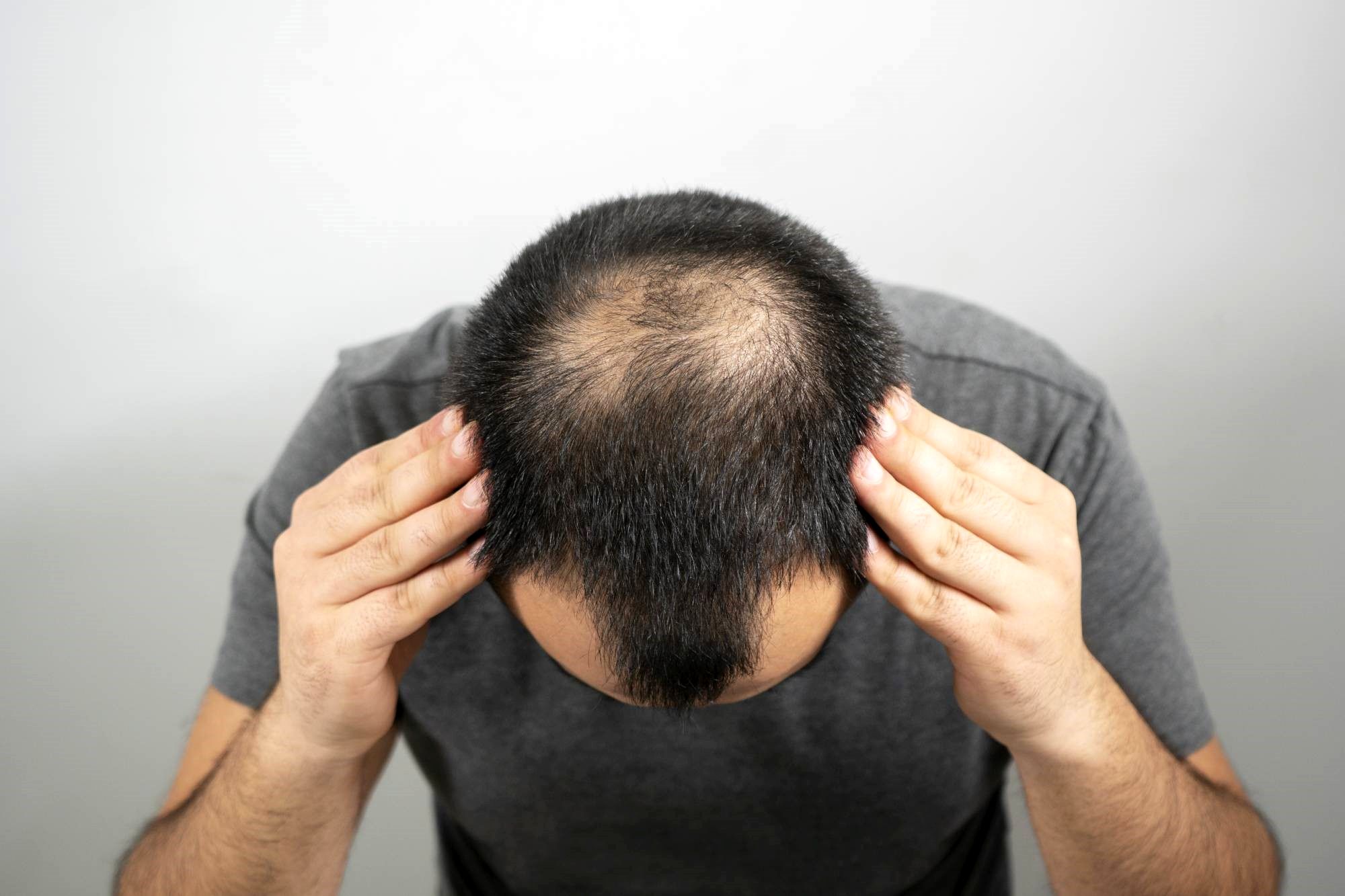 علل و روش درمان ریزش موی شدید چیست؟