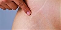 رژیم غذایی که به پوست آسیب می زند 