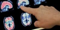 علائم جدید بیماری کرونا ؛از تاثیر بر مغز تا مشکل حرکتی