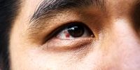 علامت این بیماری در چشمانتان ظاهر می شود 