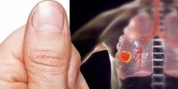 تغییر شکل انگشتان، نشانه‌ این بیماری مهلک است
