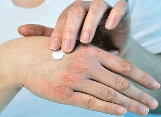 با این روش خانگی، خشکی پوست را ضربه فنی کنید