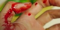 ​۱۰ ماده طبیعی برای بهبود انواع زخم