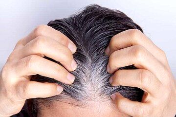 یافته‌ای جدید درباره سفید شدن مو / پای یکی از خطرناک‌ترین سرطان‌های پوستی در میان است