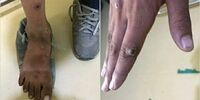 چه کسانی به آبله میمون مبتلا می‌شوند؟
