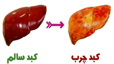 دلیل اصلی چرب شدن کبد مشخص شد / این افراد سیروز کبدی می‌گیرند 2