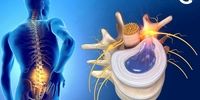 علائم دیسک کمر چیست؟ اصلی ترین نشانه های دیسک کمر از نظر دکتر محمدرضا شاه محمدی