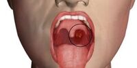 خطرناک ترین علائم در دهان که از ابتلا به سرطان خبر می‌دهند