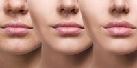 چه افرادی کاندیدای مناسب تزریق ژل به لب هستند؟