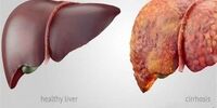 ۲۰ نشانه عملکرد بد کبد

