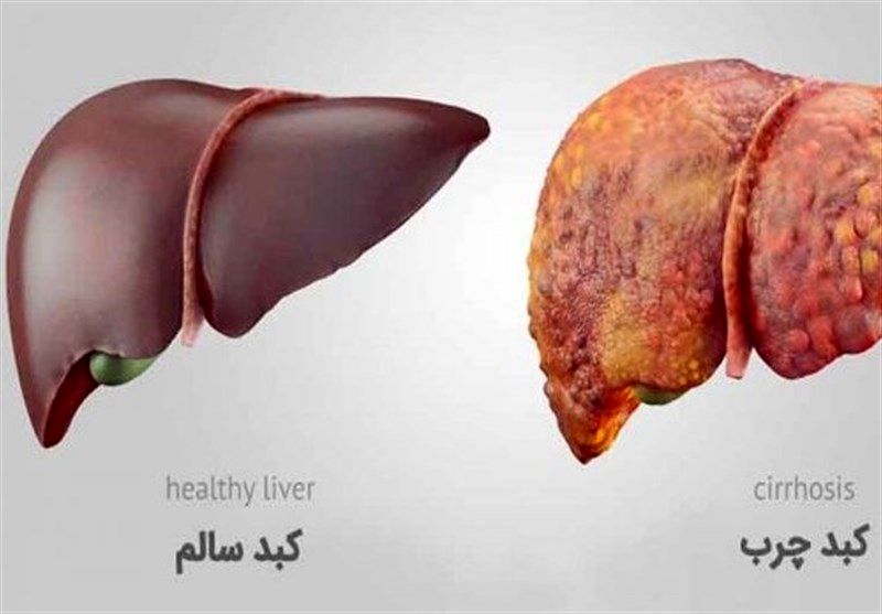 درمان فوری کبد چرب با 12 غذای مفید + 6 غذای خطرناک برای کبد