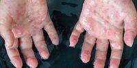 درخواست بایدن نسبت به نگرانی همگانی درباره آبله میمونی