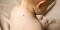 شایعترین سن برای ابتلا به آبله مرغان چند سال است؟