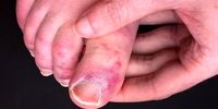 علت ابتلا به انگشت پای کوویدی چیست؟