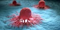 علائم سرطان کبد را بشناسید+ عکس