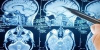 درمان مرگبارترین تومور‌های مغزی با چند راهکار ساده
