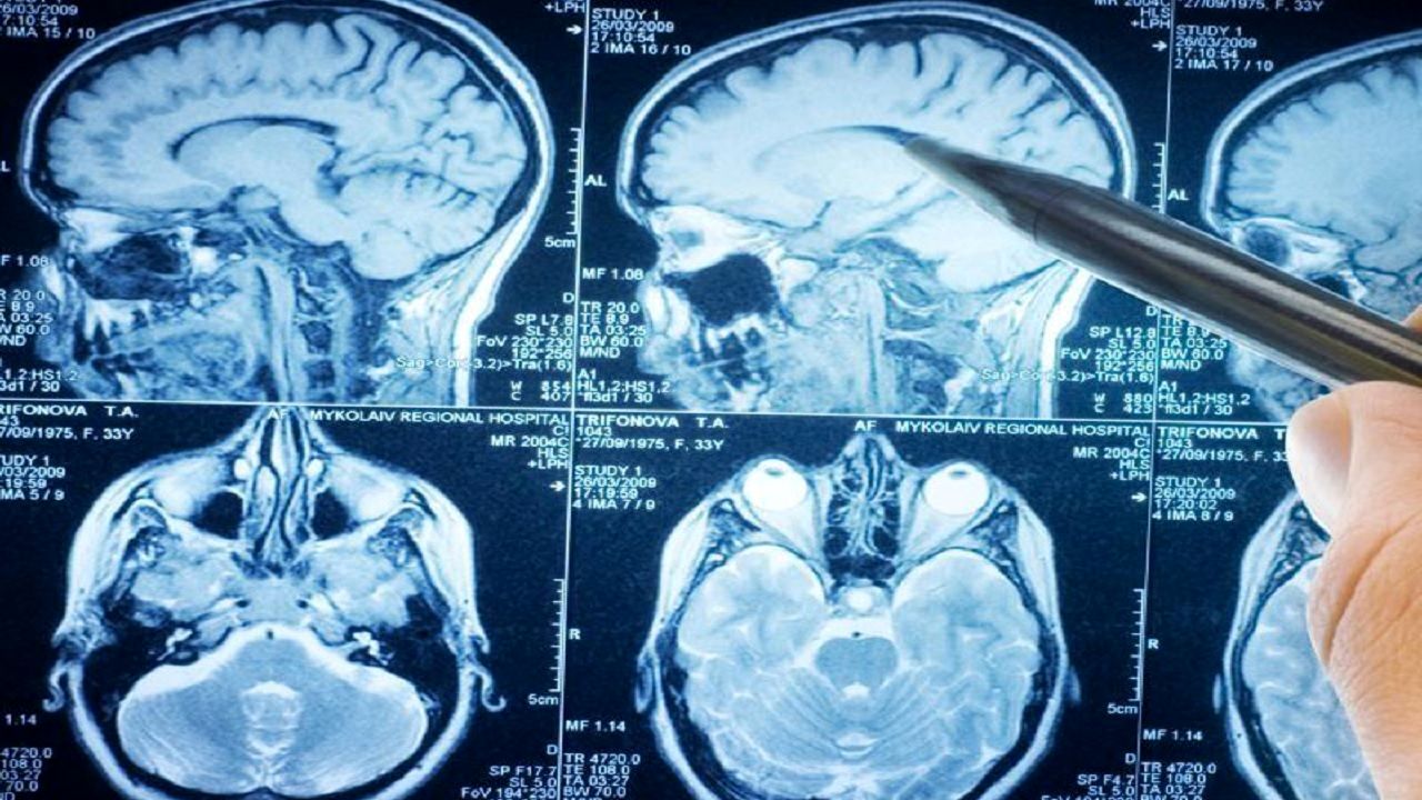درمان مرگبارترین تومور‌های مغزی با چند راهکار ساده

