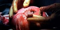عکسی حیرت انگیز از جنینی که پیش از تولد دست جراحش را فشرد