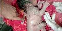 تصاویری تعجب‌برانگیز از تولد نوزاد پسر با سه دست+ فیلم