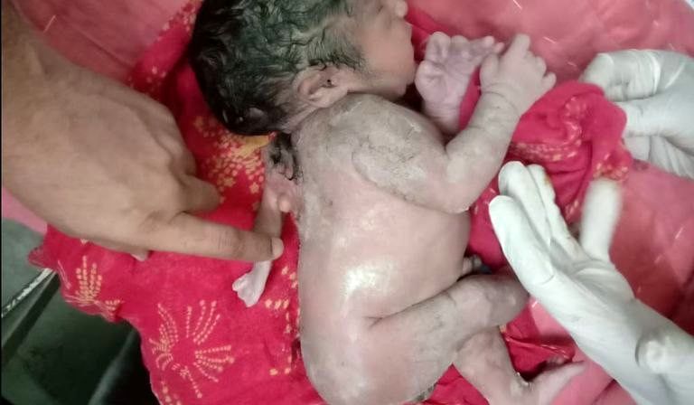 تصاویری تعجب‌برانگیز از تولد نوزاد پسر با سه دست+ فیلم