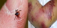 شناسایی ۲ بیمار مبتلا به تب کریمه‌کنگو در ایران/ توصیه‌های مهم برای جلوگیری از ابتلا