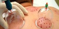 این افراد به هیچ وجه نباید حجامت کنند!