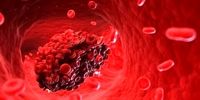 علائم خطرناک لخته‌ شدن خون چیست؟
