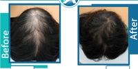 روش NFP برای درمان قطعی ریزش مو در ایران اجرا شد