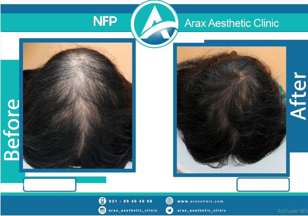  روش NFP برای درمان قطعی ریزش مو در ایران اجرا شد