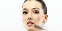 درمان قطعی لک صورت | روش های خانگی از بین بردن لک صورت