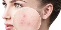 جوش زدن در اطراف چشم نشانه چیست؟