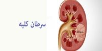 این نشانه ها علائم سرطان کلیه است 