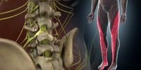 ارتباط درد سیاتیک با تنگی کانال نخاعی: علت، درمان
