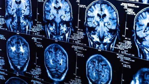 تاثیر شبه آلزایمر و پارکینسون کرونا روی مغز