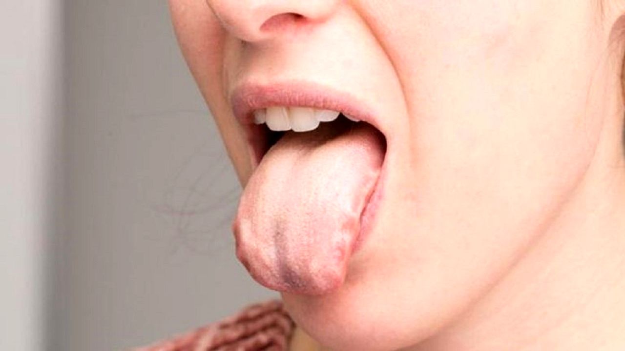 سوزش زبان نشانه این بیماری‌  خطرناک است؛ جدی بگیرید