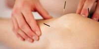 طب سوزنی چگونه به درمان کمر درد کمک می‌کند؟
