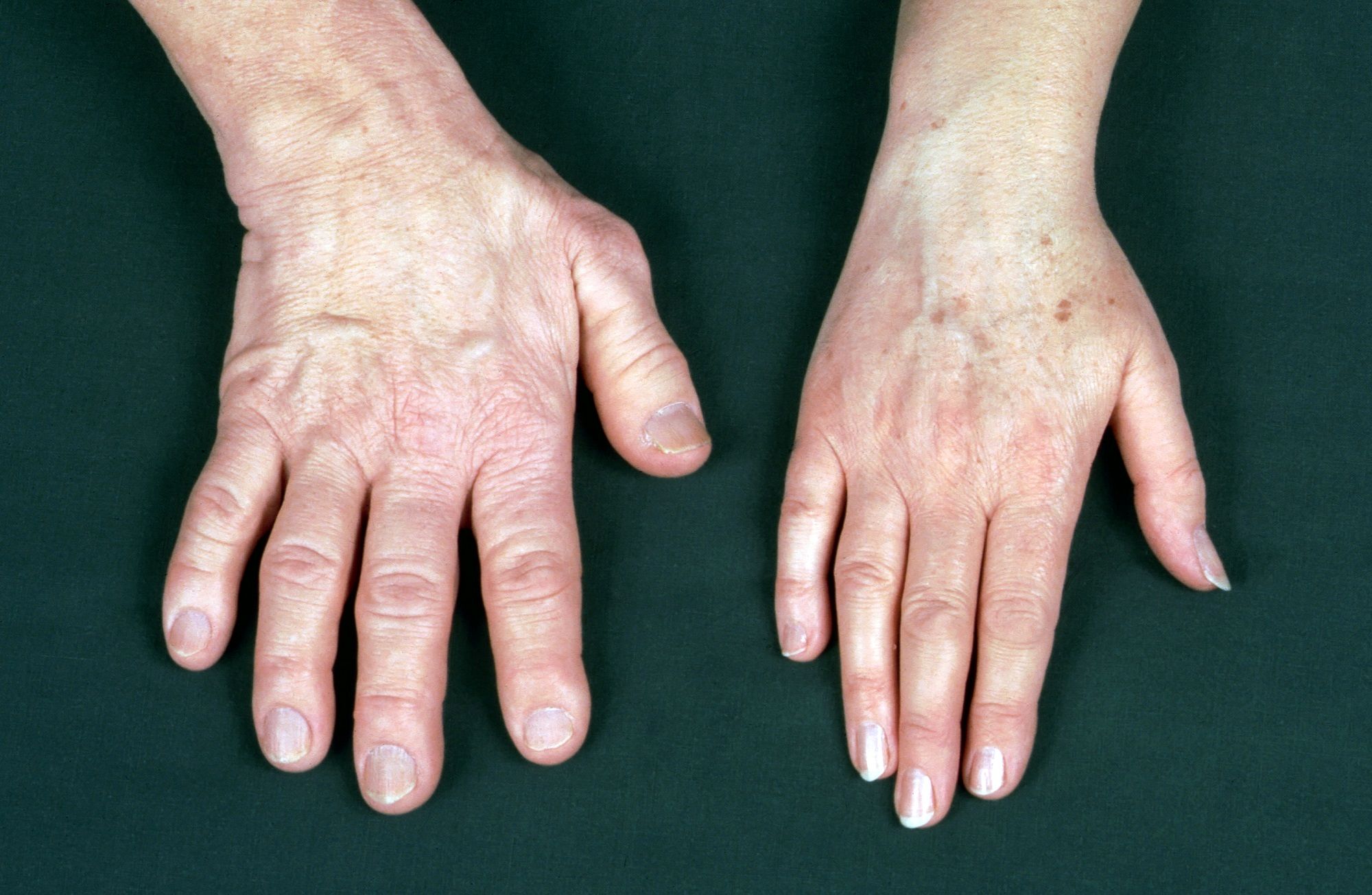 نشانه های عجیب یک بیماری ؛مراقب رشد اضافی دست و پاهایتان باشید