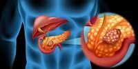 این سرطان نشانه ندارد؛وقتی متوجه بیماری می شویم که کار از کار گذشته است 