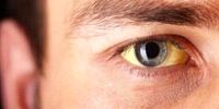 لکه‌های زرد چشم نشانه ابتلا به این بیماری خطرناک است